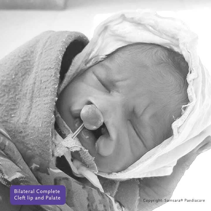 about page what is cleft samsarapaediacare 01