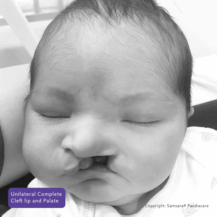 about page what is cleft samsarapaediacare 02